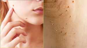 5 Highly Effective Wart Removal Creams That Work Consistently With Regular Use                                                                                    